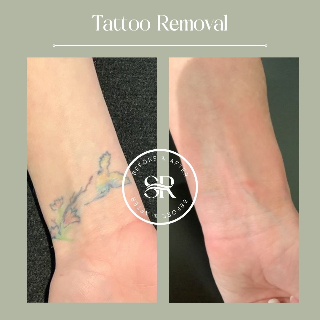 Before and after laser tattoo removal at Severn River Medspa