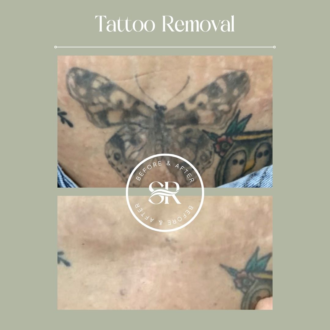 Before and after laser tattoo removal at Severn River Medspa