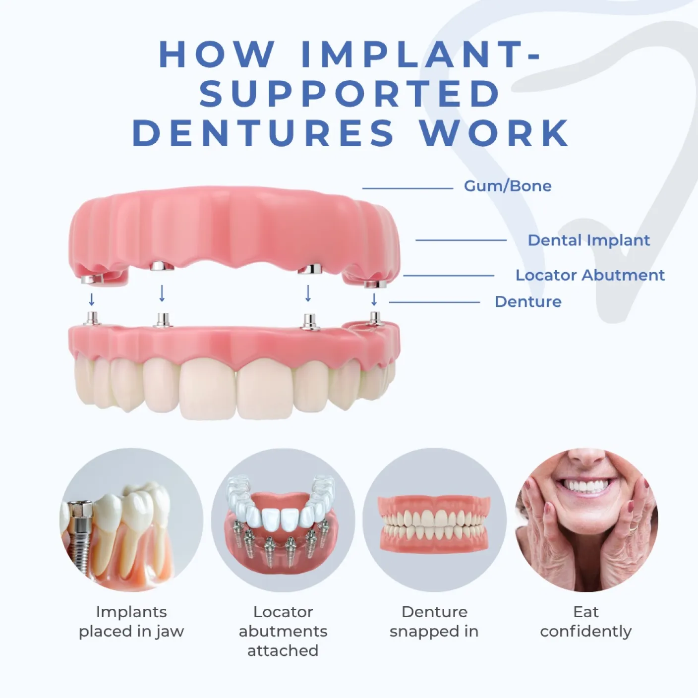 How Implant-Supported Dentures Work