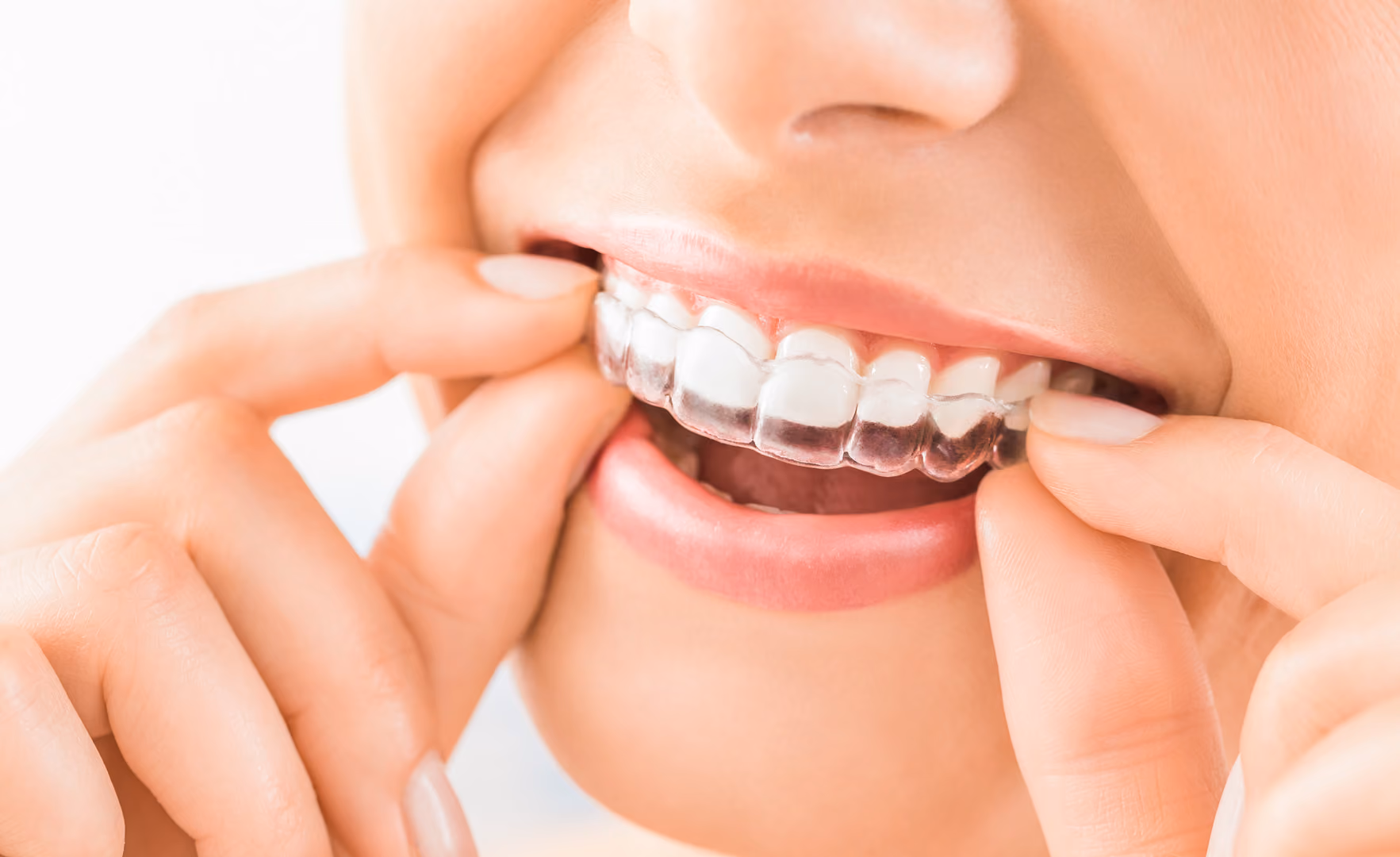 SureSmile Clear Aligners