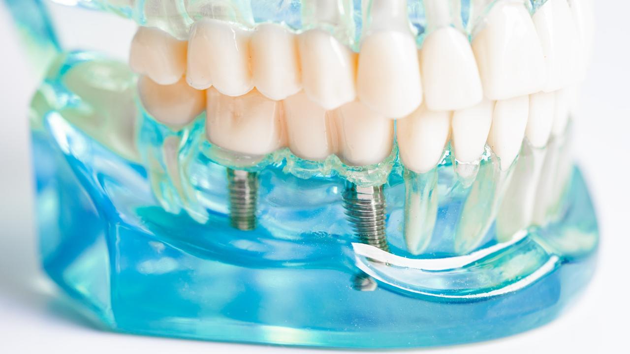 What are Dental Implants