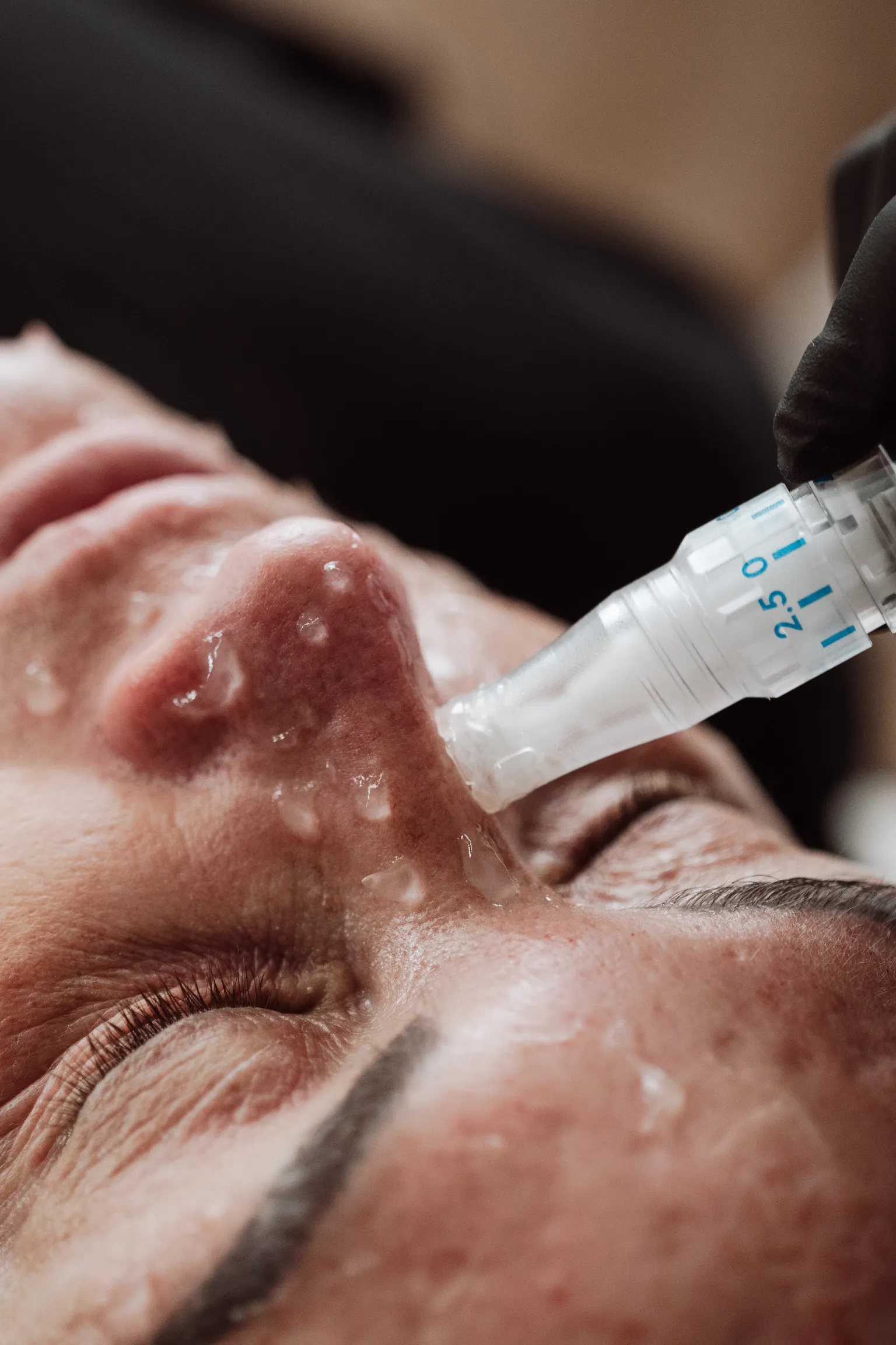 SkinPen® closeup
