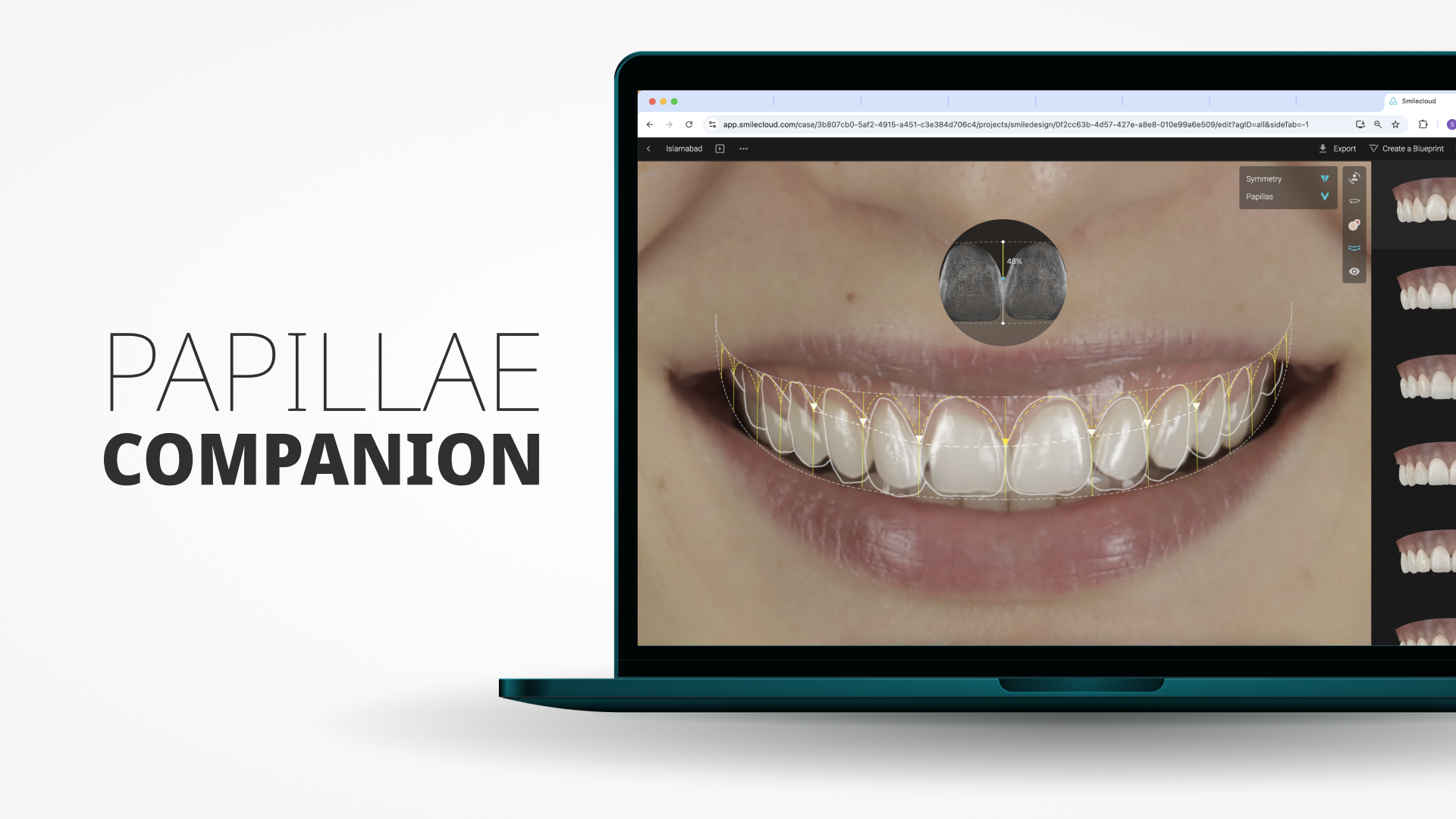 Papillae Height in Smile Design