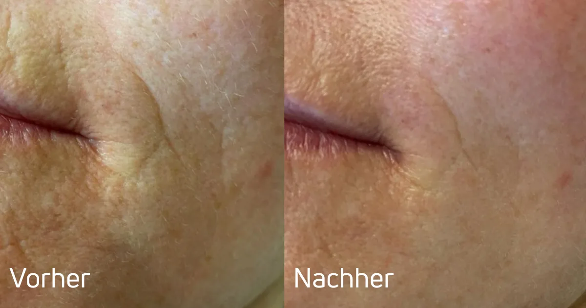 Hautbild vor und nach einer Microneedling-Behandlung