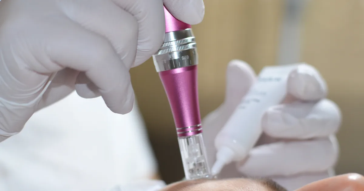 Microneedling-Behandlung an der Stirn mit einem Microneedling-Pen