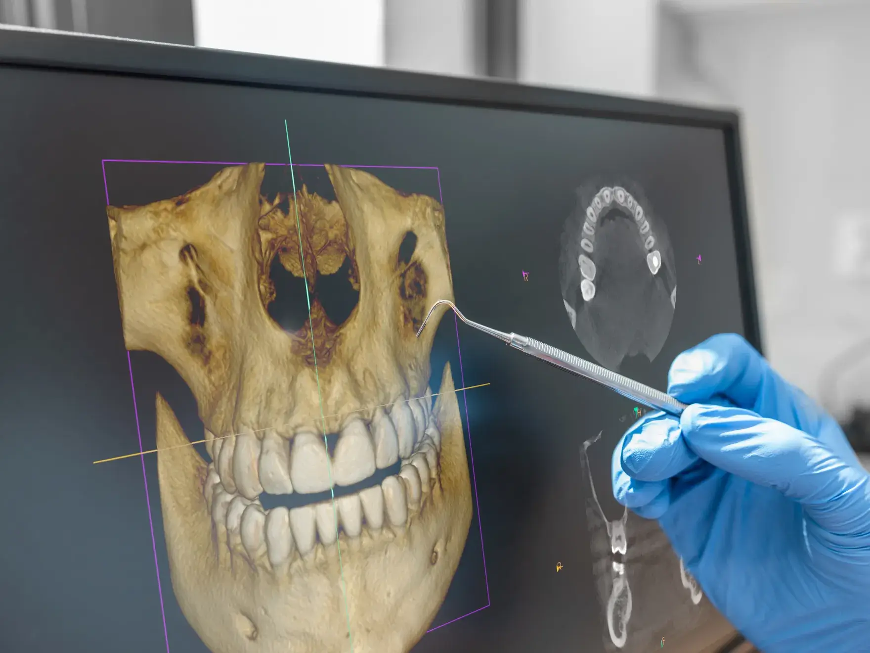 A gloved hand points at a digital 3D model of a human skull on a computer screen.