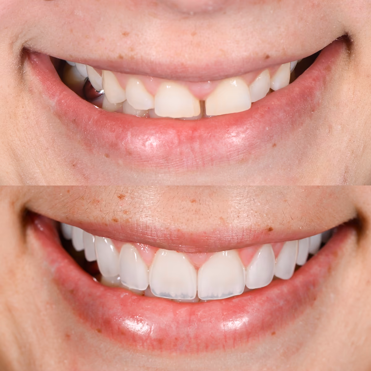 Porcelain Veneers San Francisco - Smile Transformation