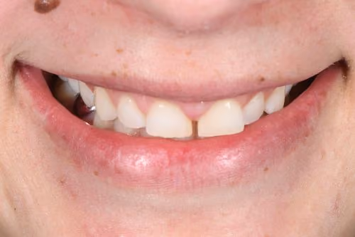 A close-up view of a person smiling, showing a noticeable gap between their front teeth.
