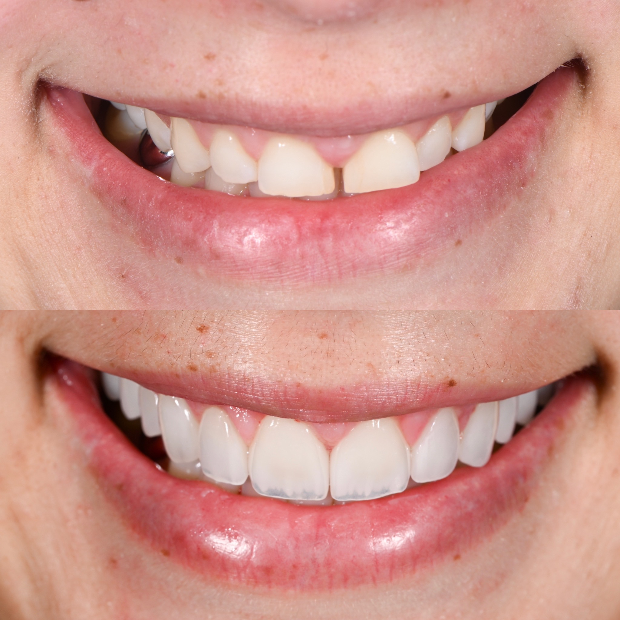 Veneer Case 1