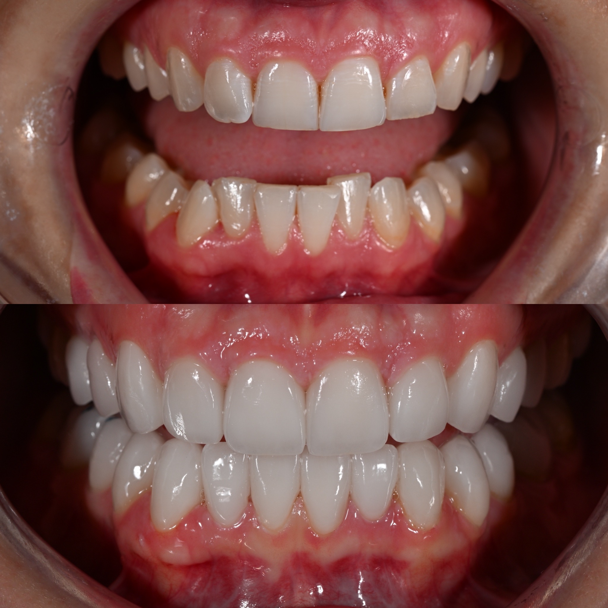 Veneer Case 11