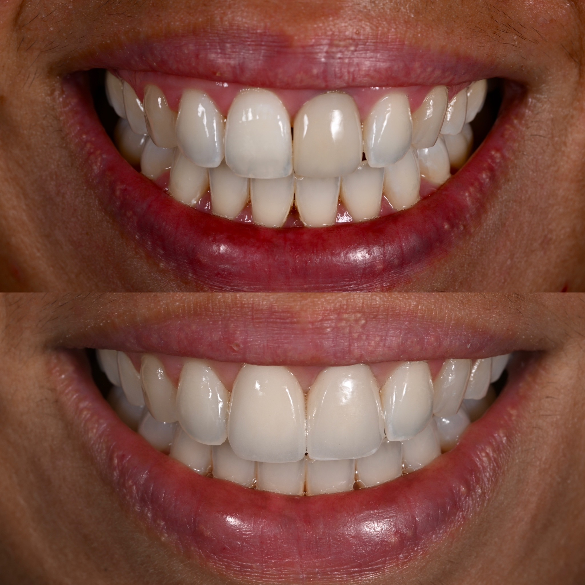 Veneer Case 30