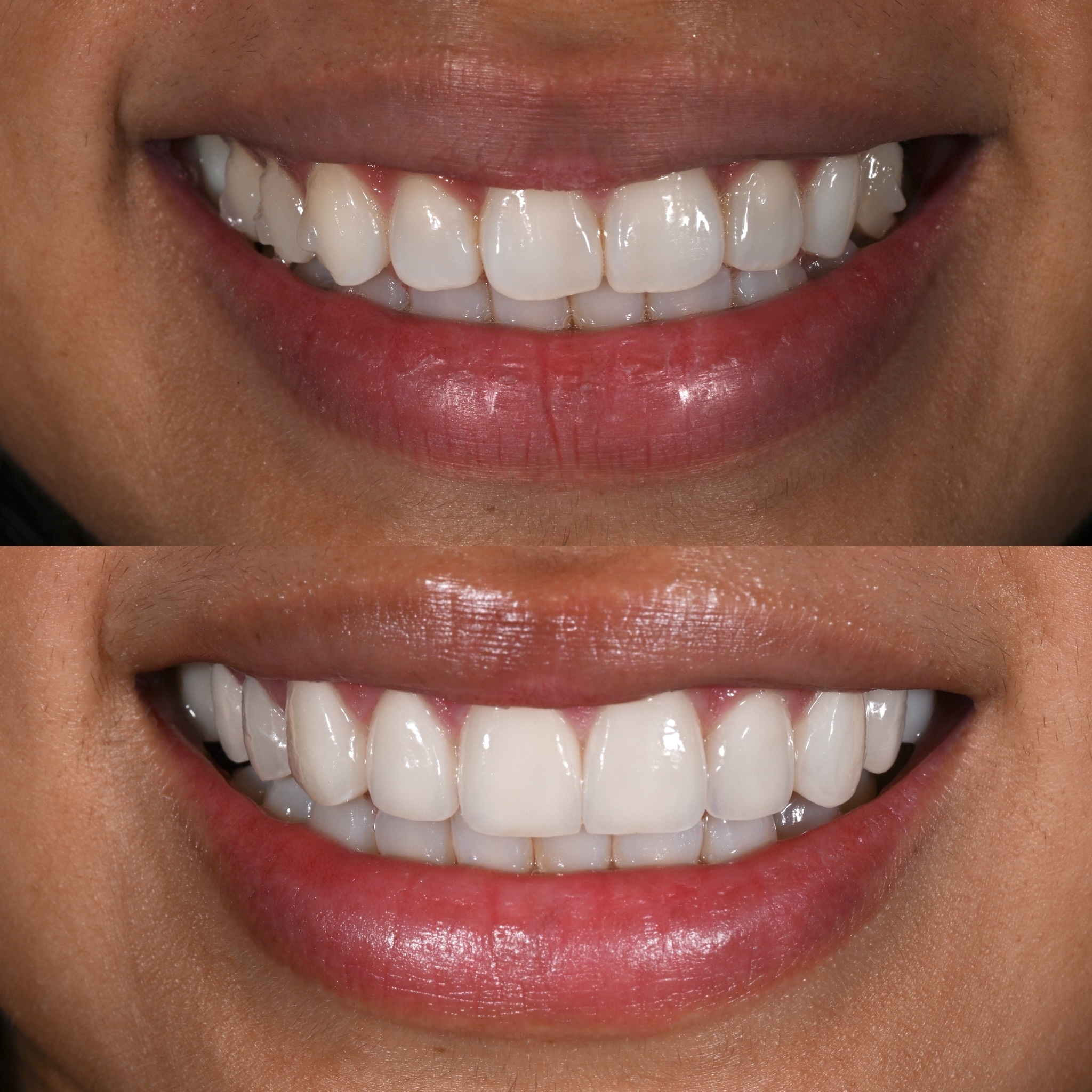 Veneer Case 22
