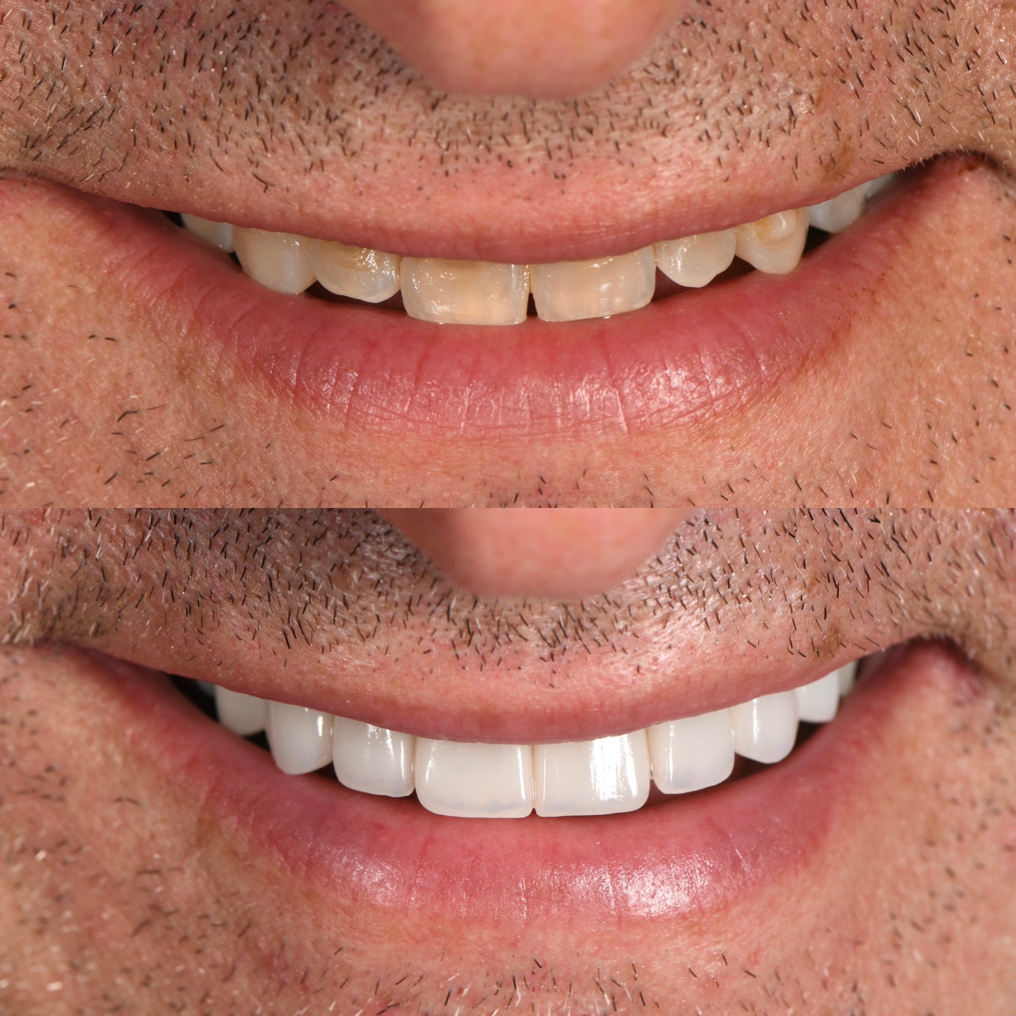Veneer Case 28