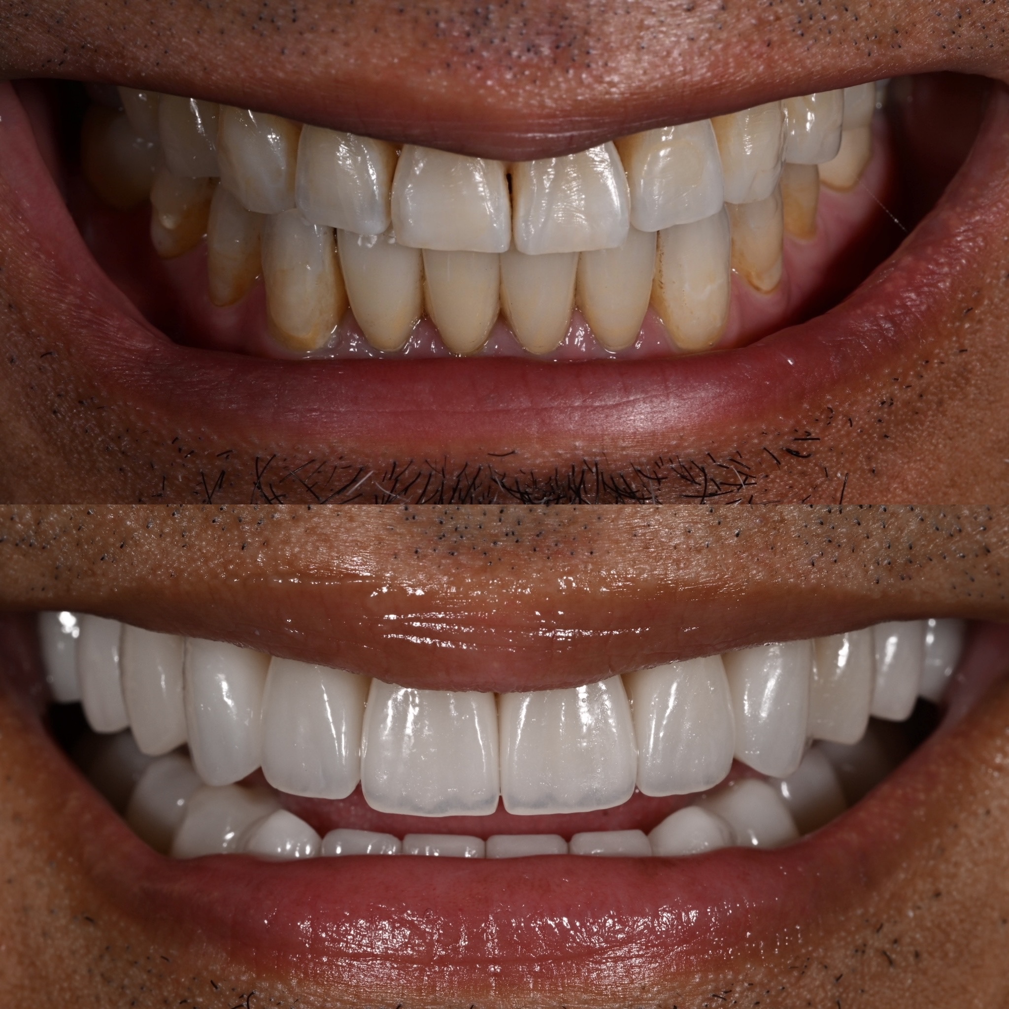 Veneer Case 24