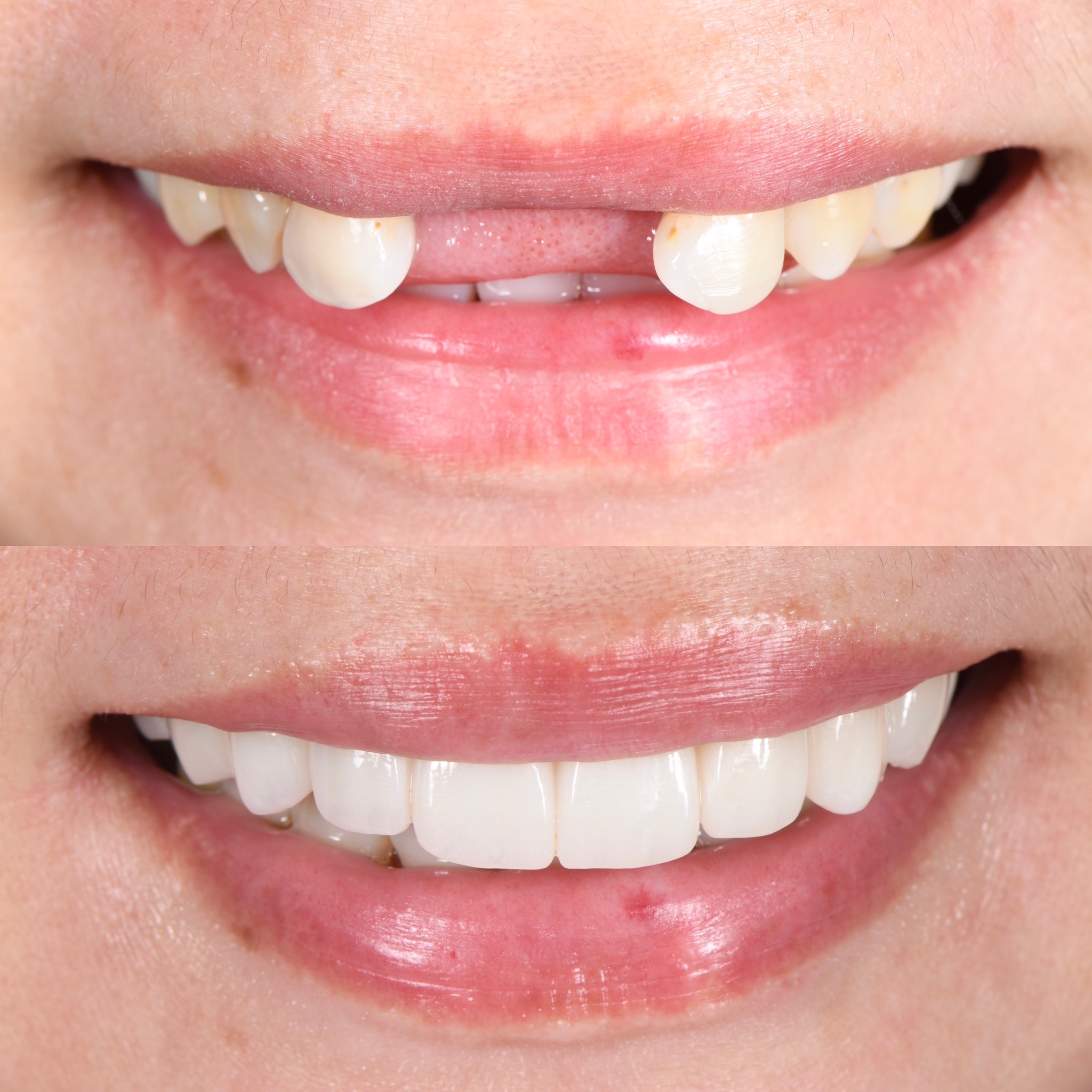 Veneer Case 26