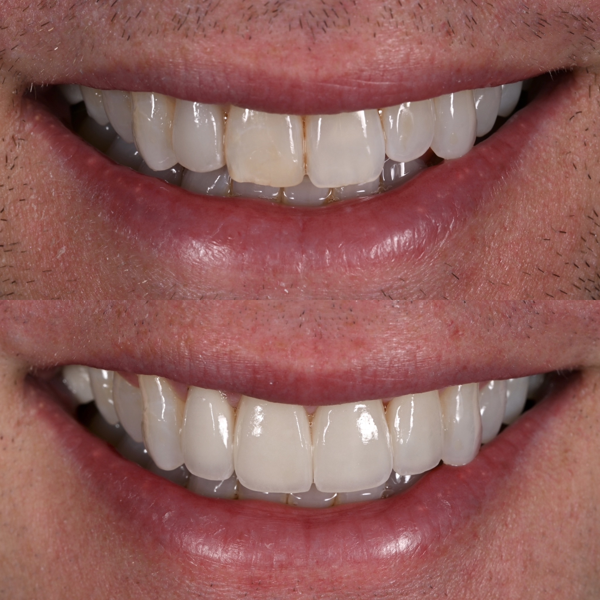 Veneer Case 27