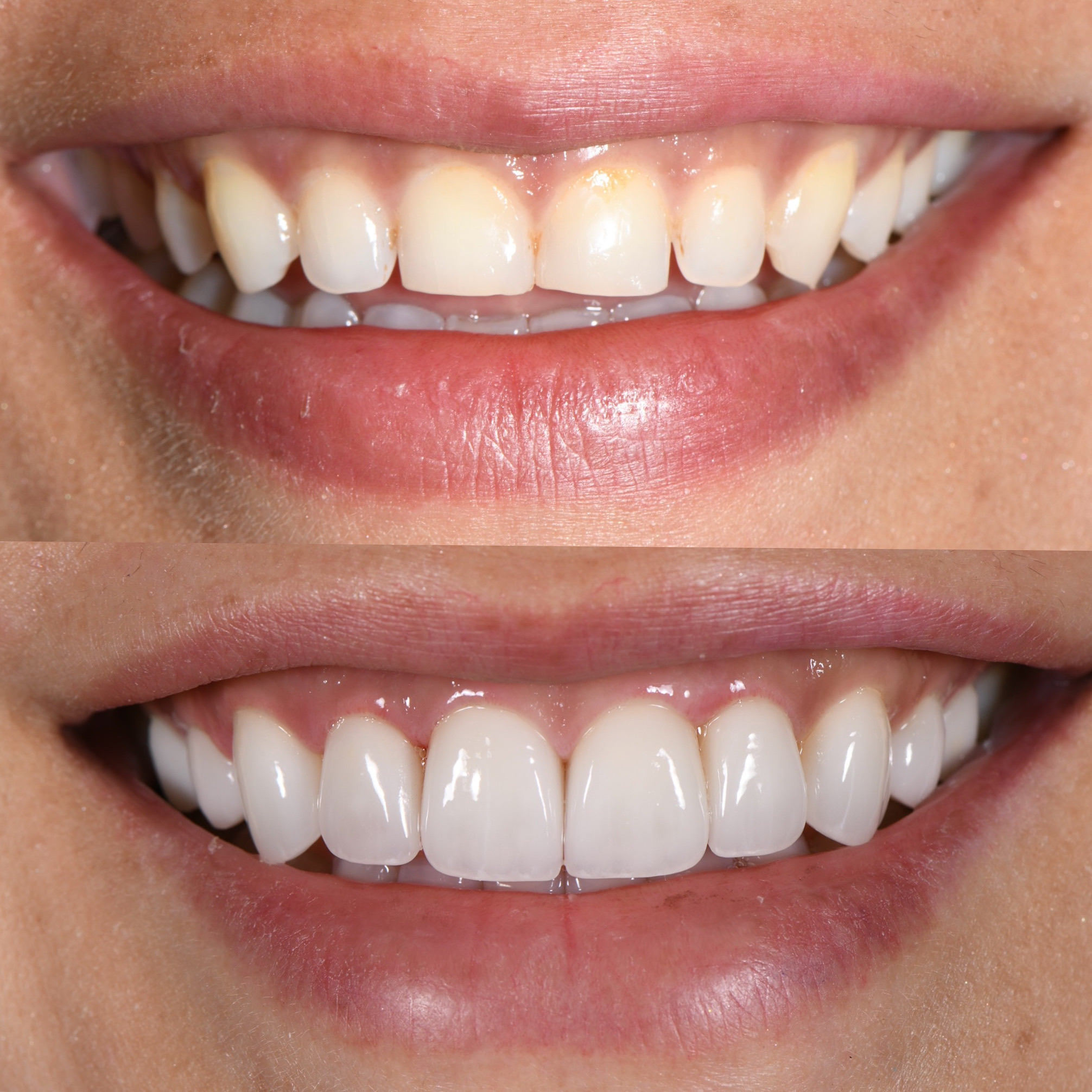 Veneer Case 21
