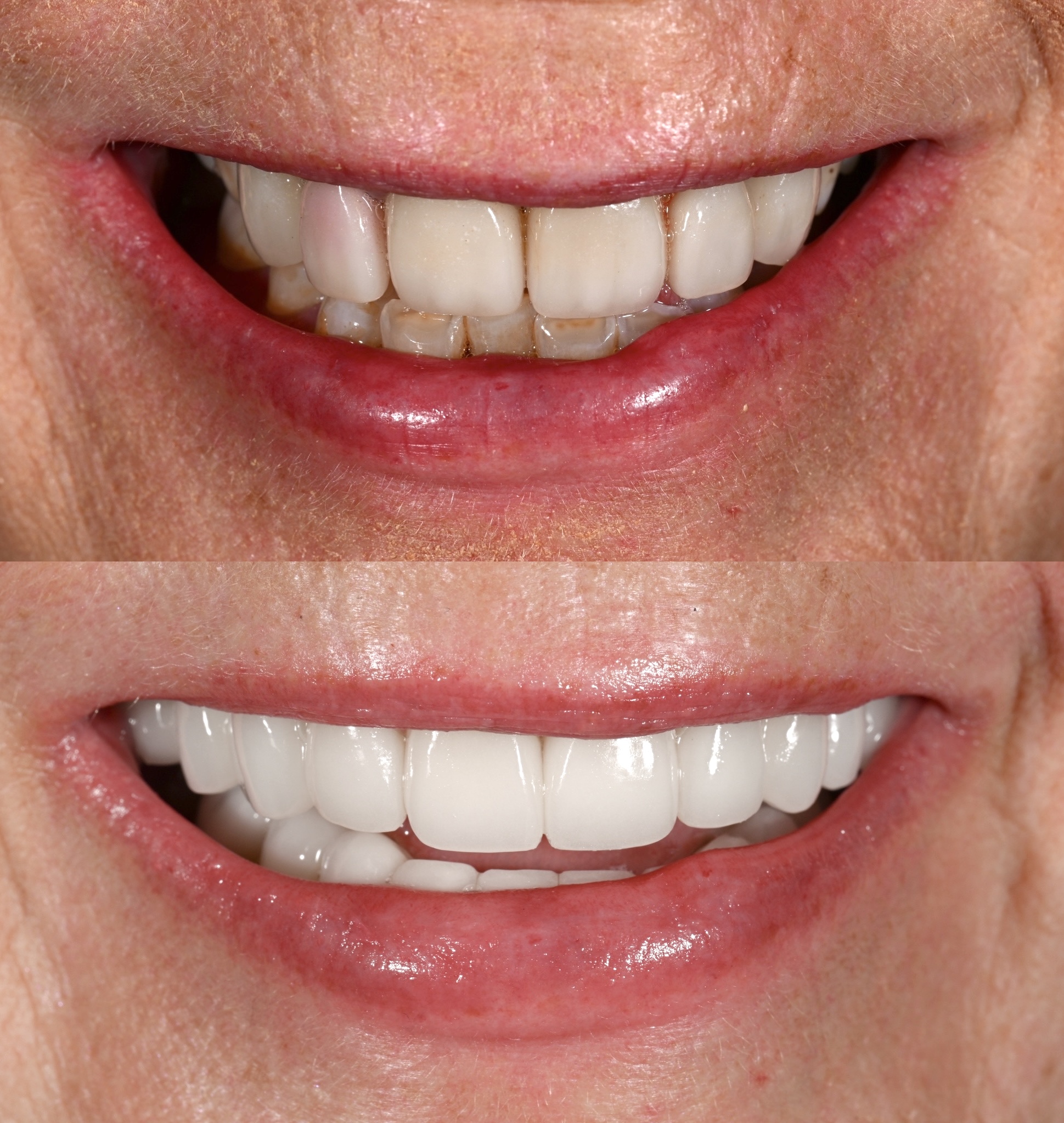 Veneer Case 23