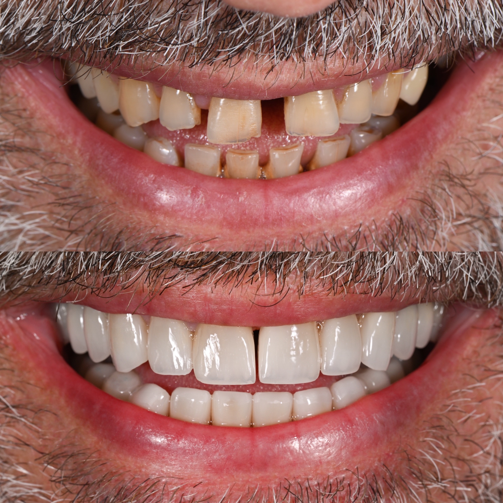 Veneer Case 29