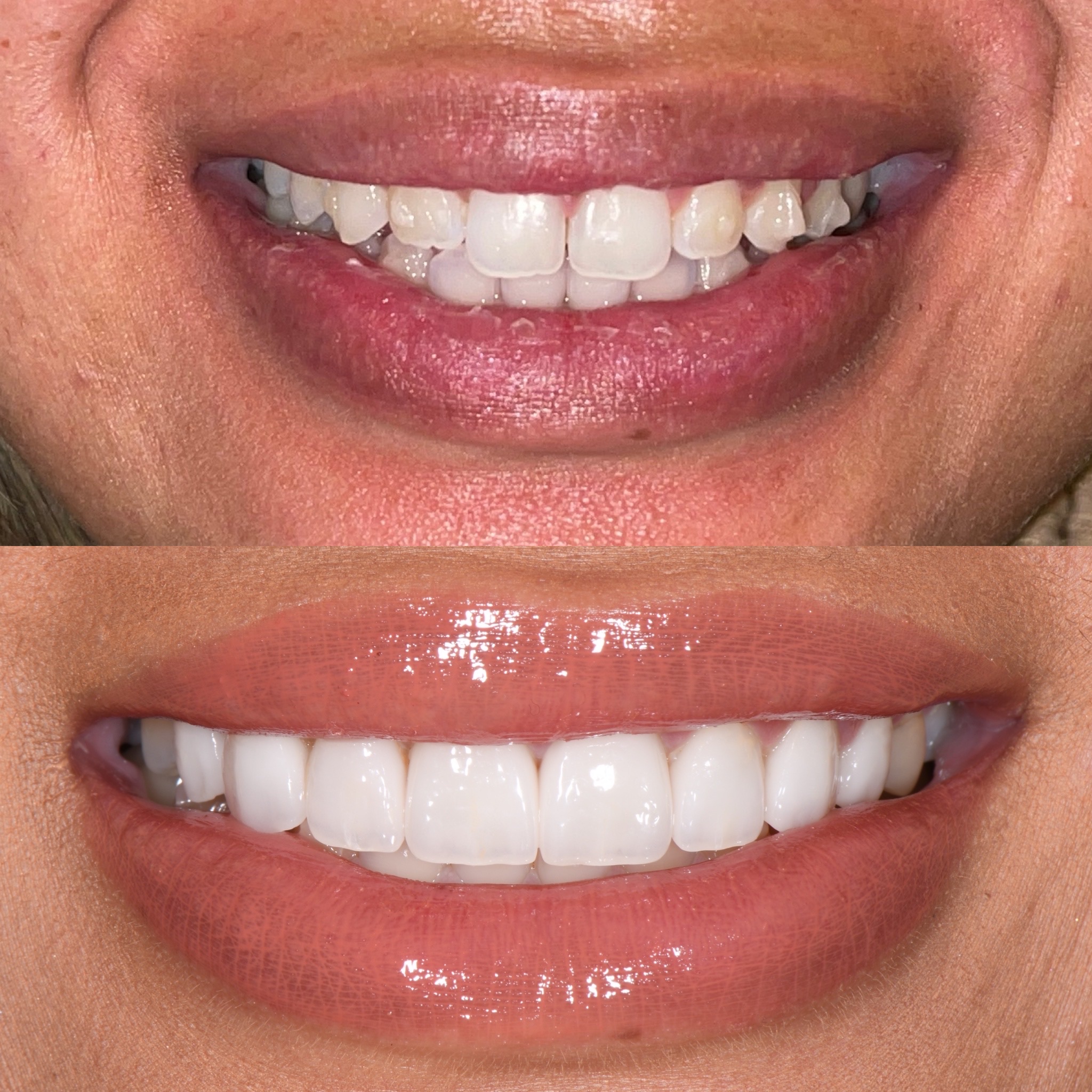 Veneer Case 18