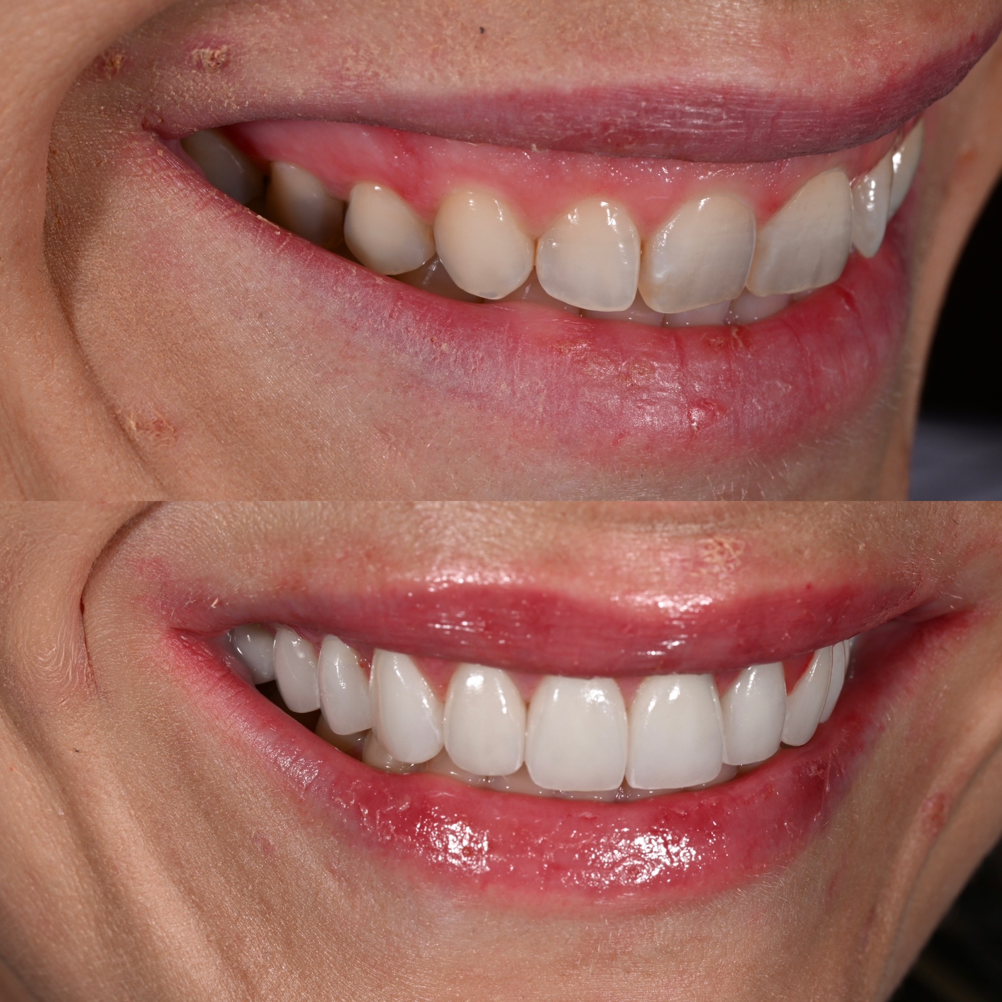 Veneer Case 13