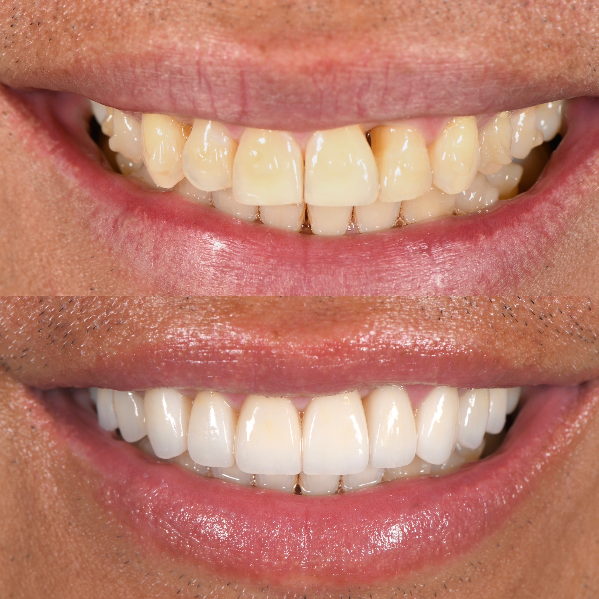 Veneer Case 15
