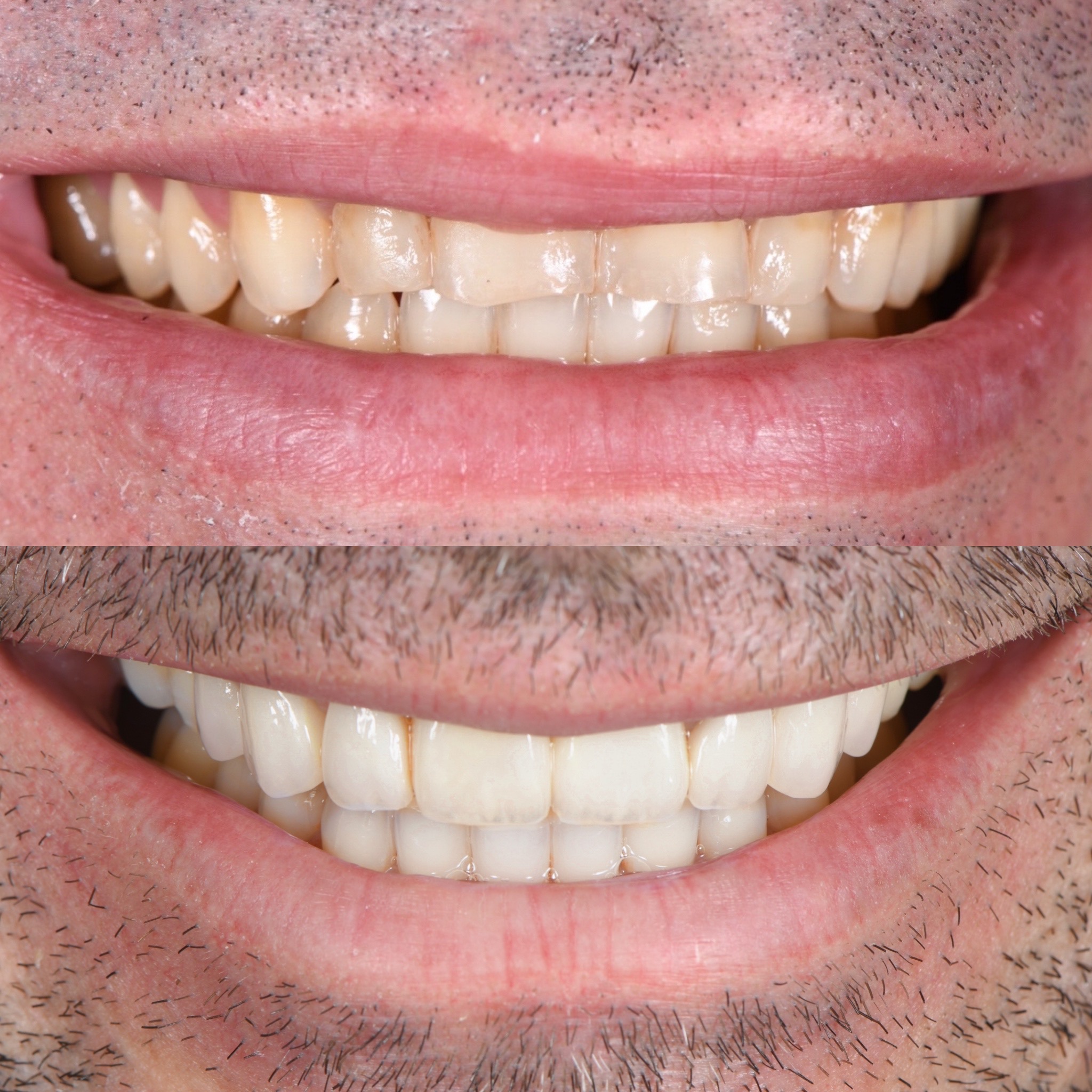 Veneer Case 20