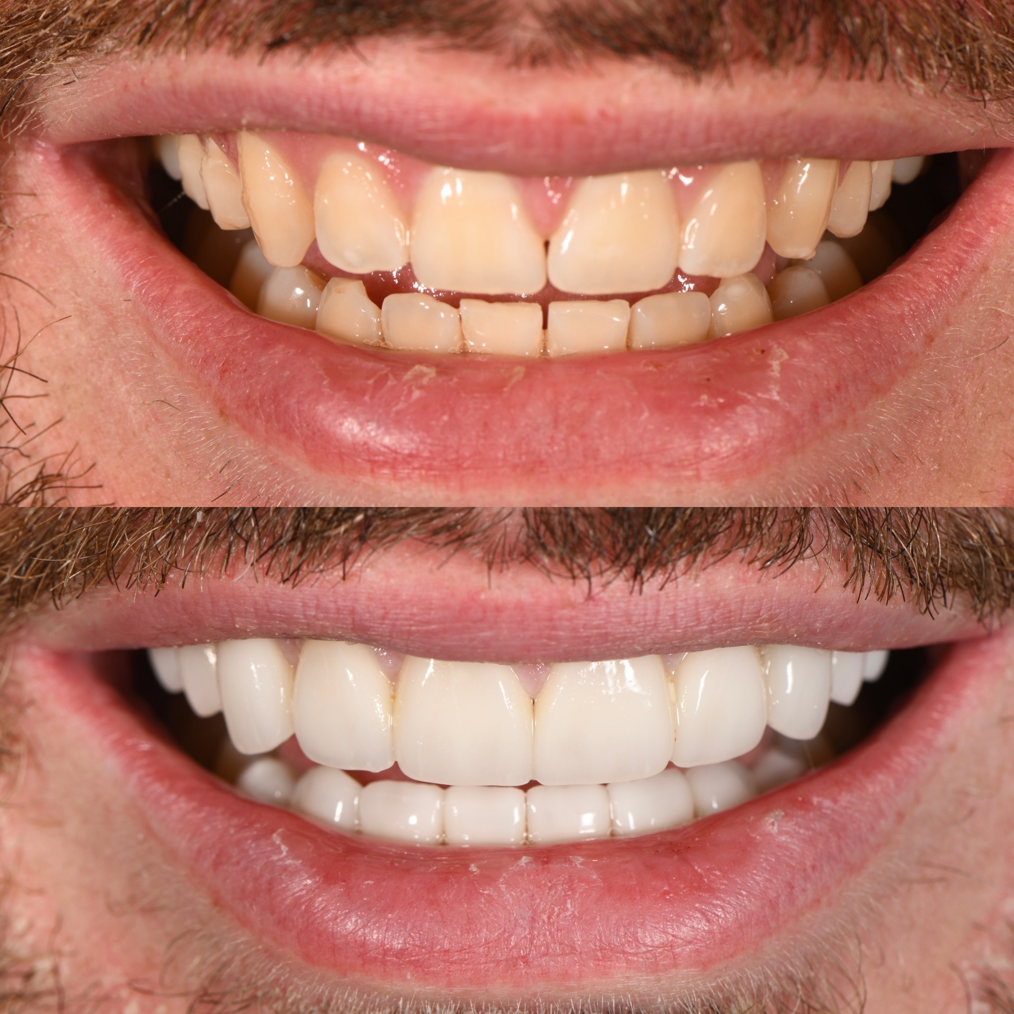 Veneer Case 16