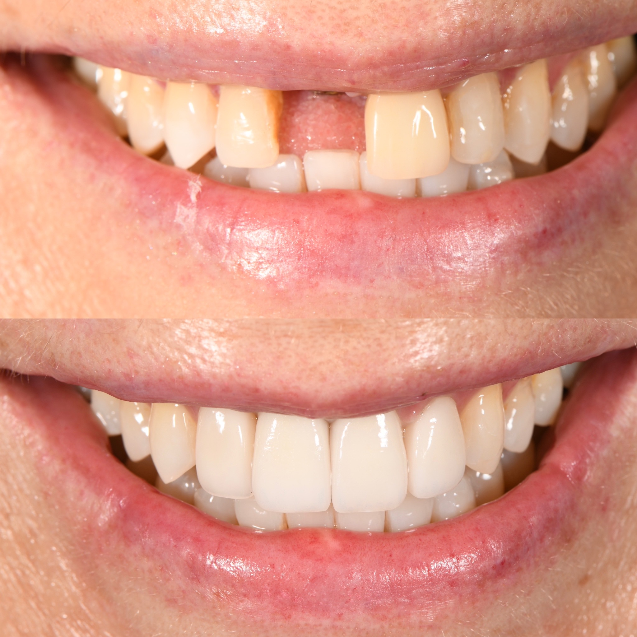 Veneer Case 14