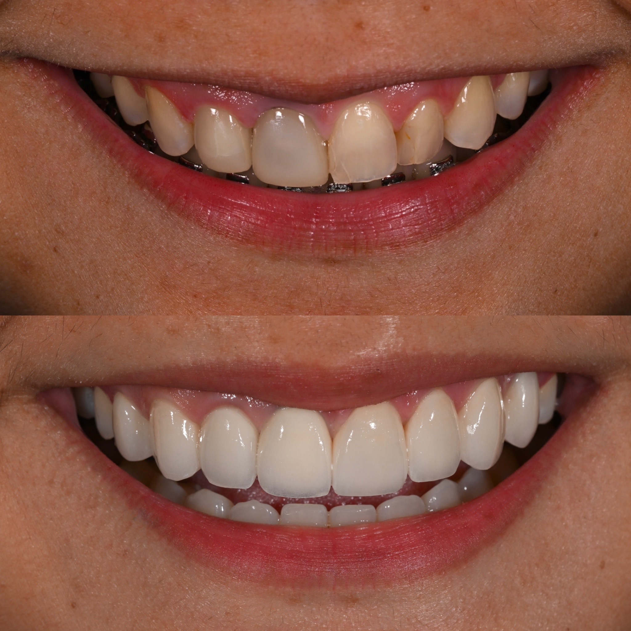 Veneer Case 17