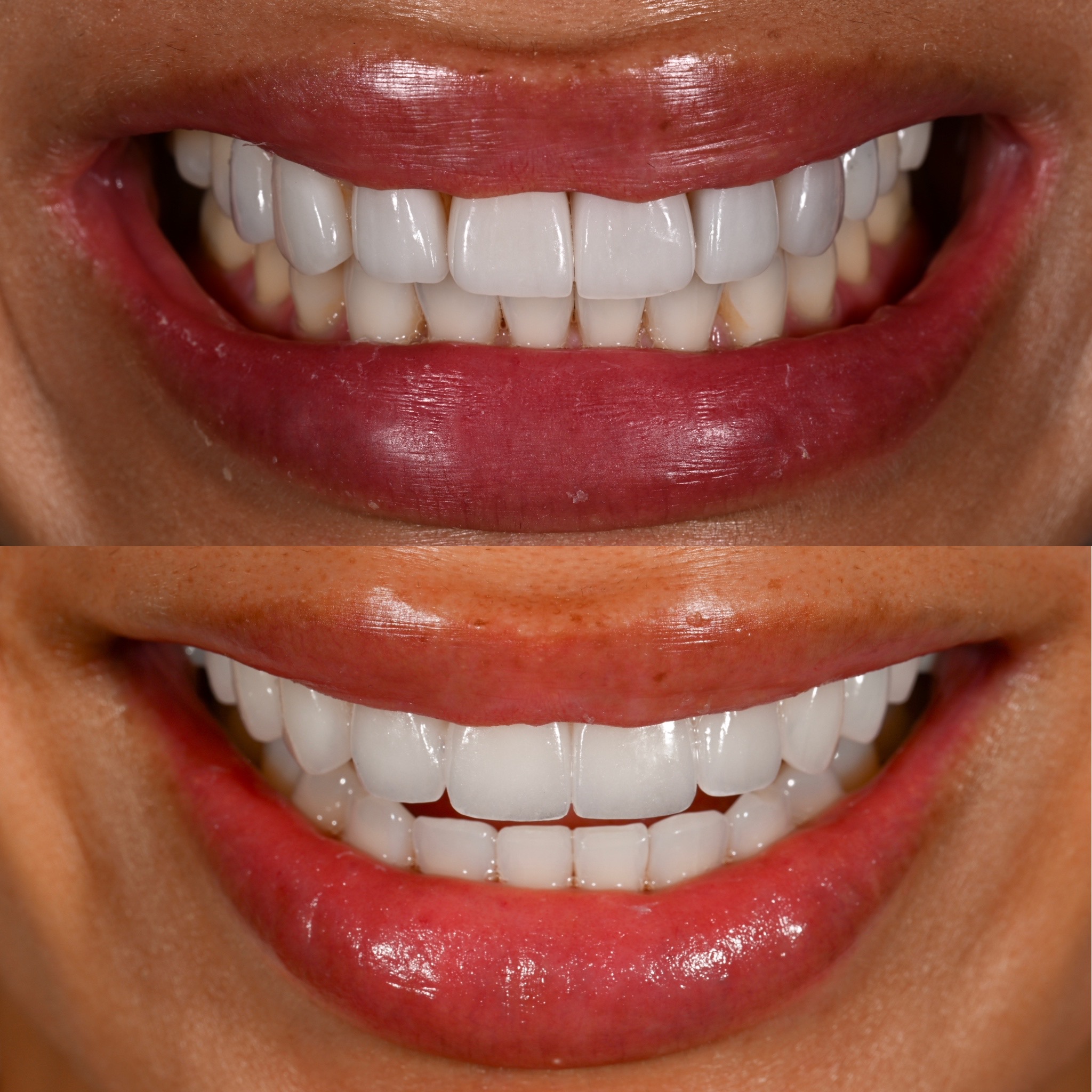 Veneer Case 9