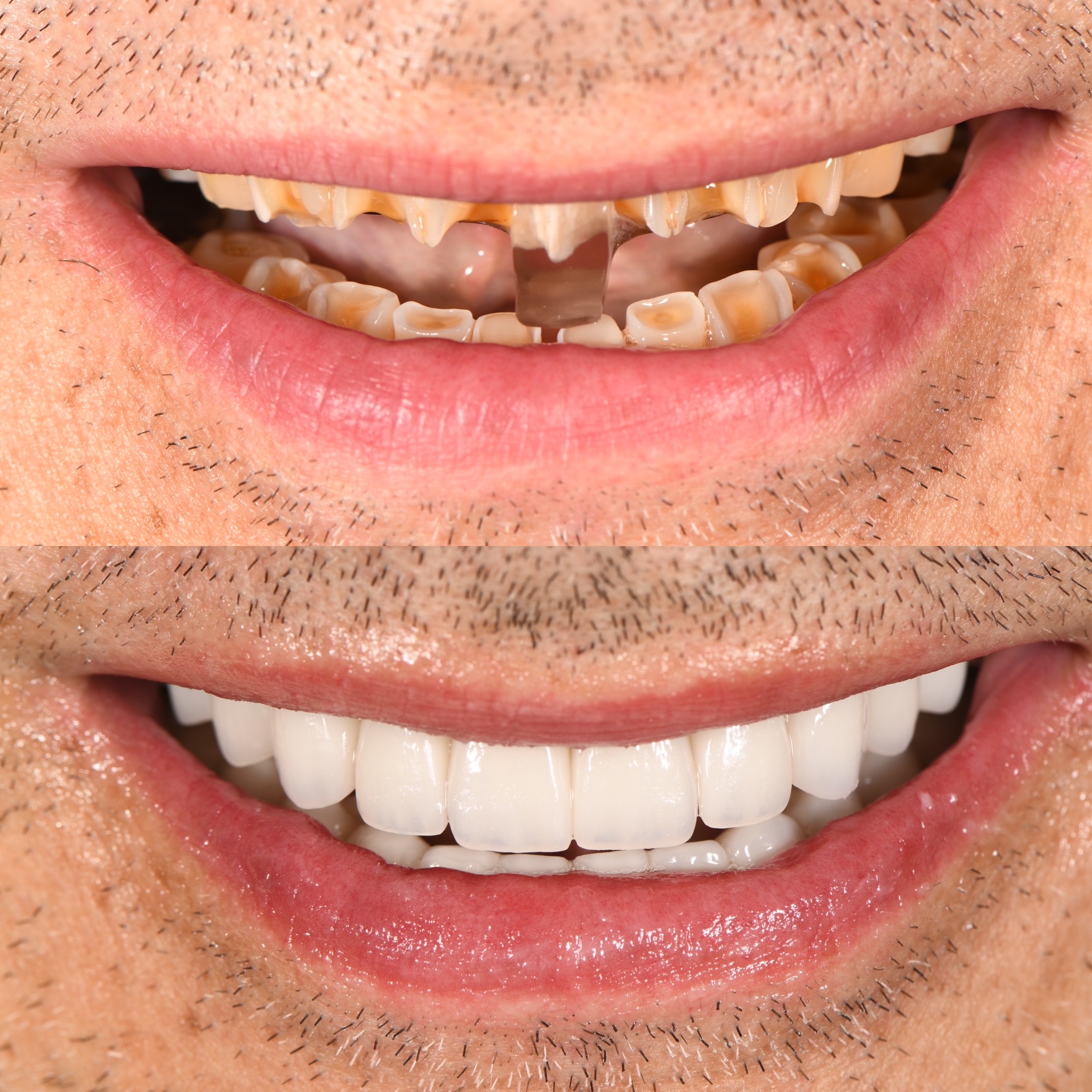 Veneer Case 4