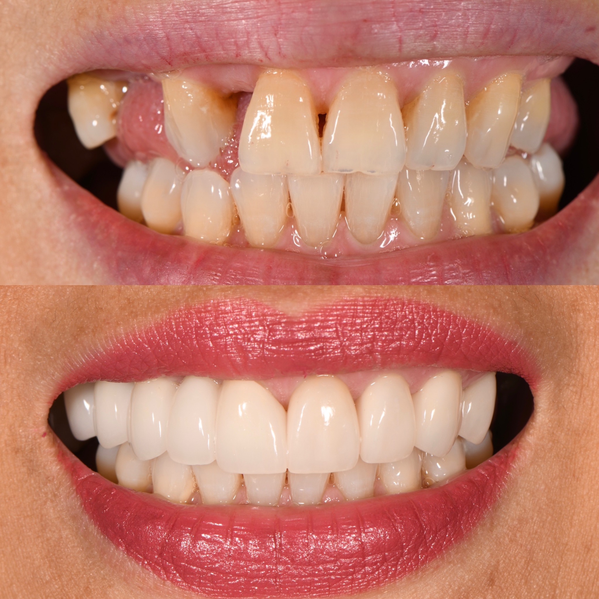 Veneer Case 8