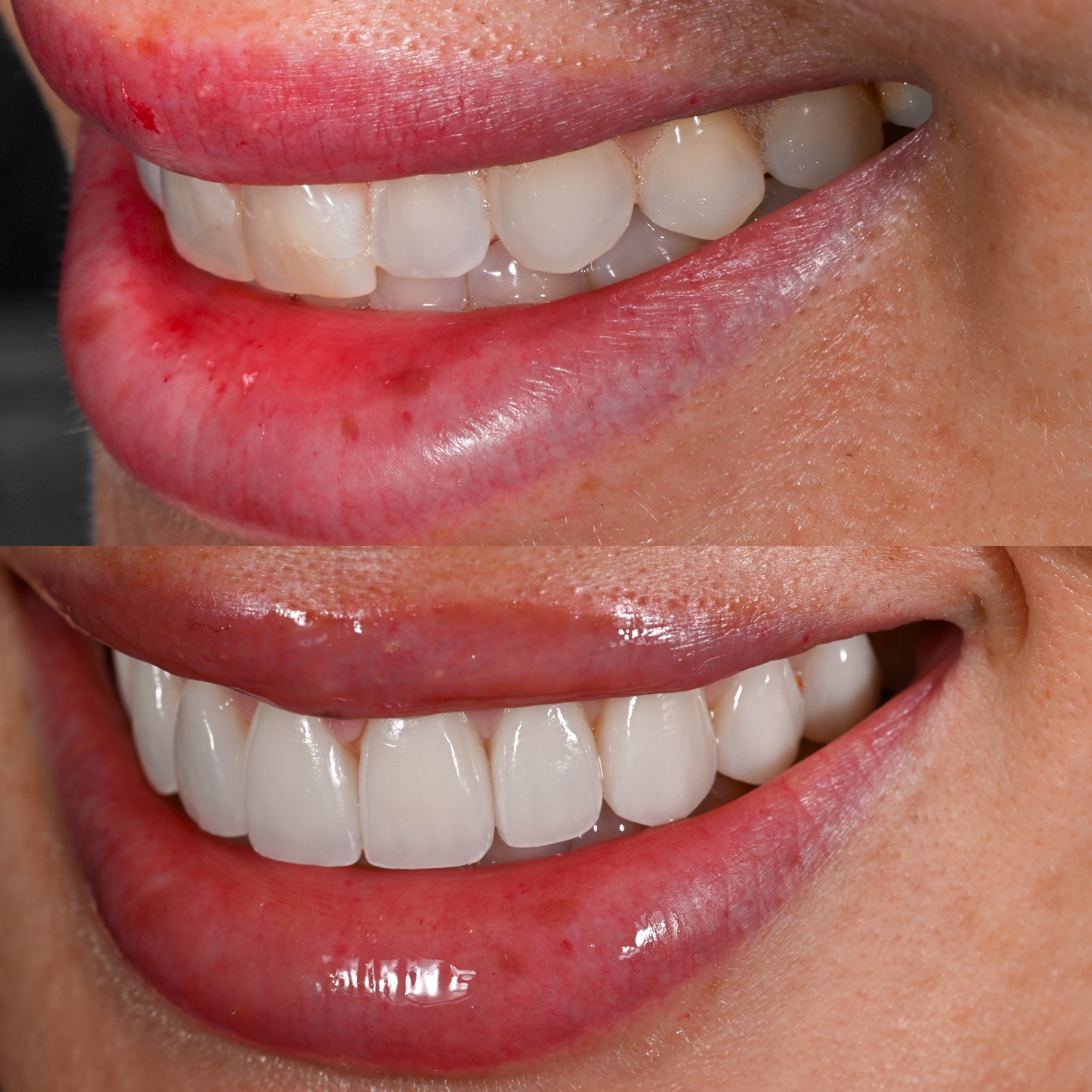 Veneer Case 7