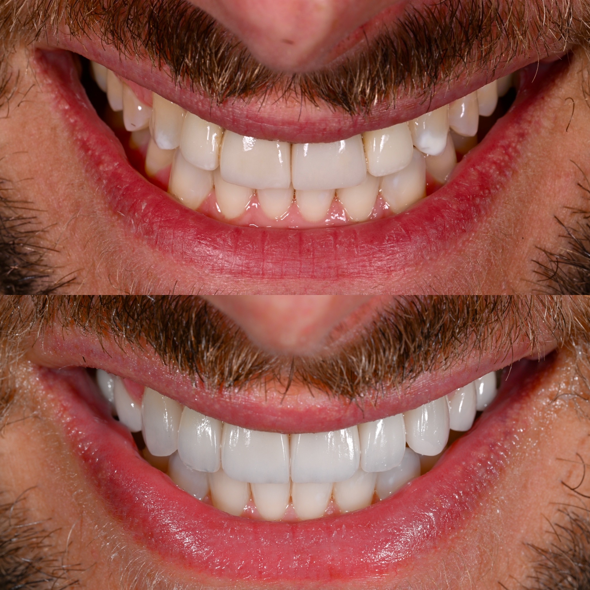 Veneer Case 5