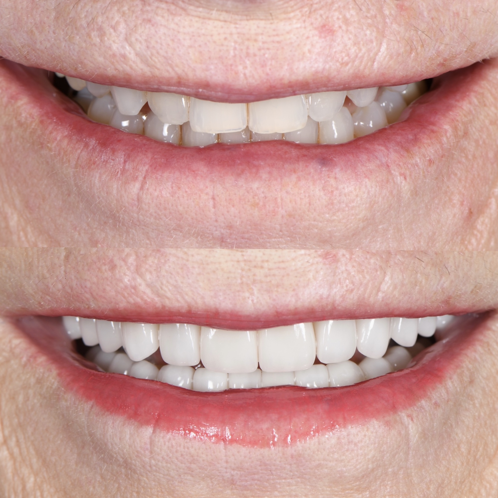 Veneer Case 6