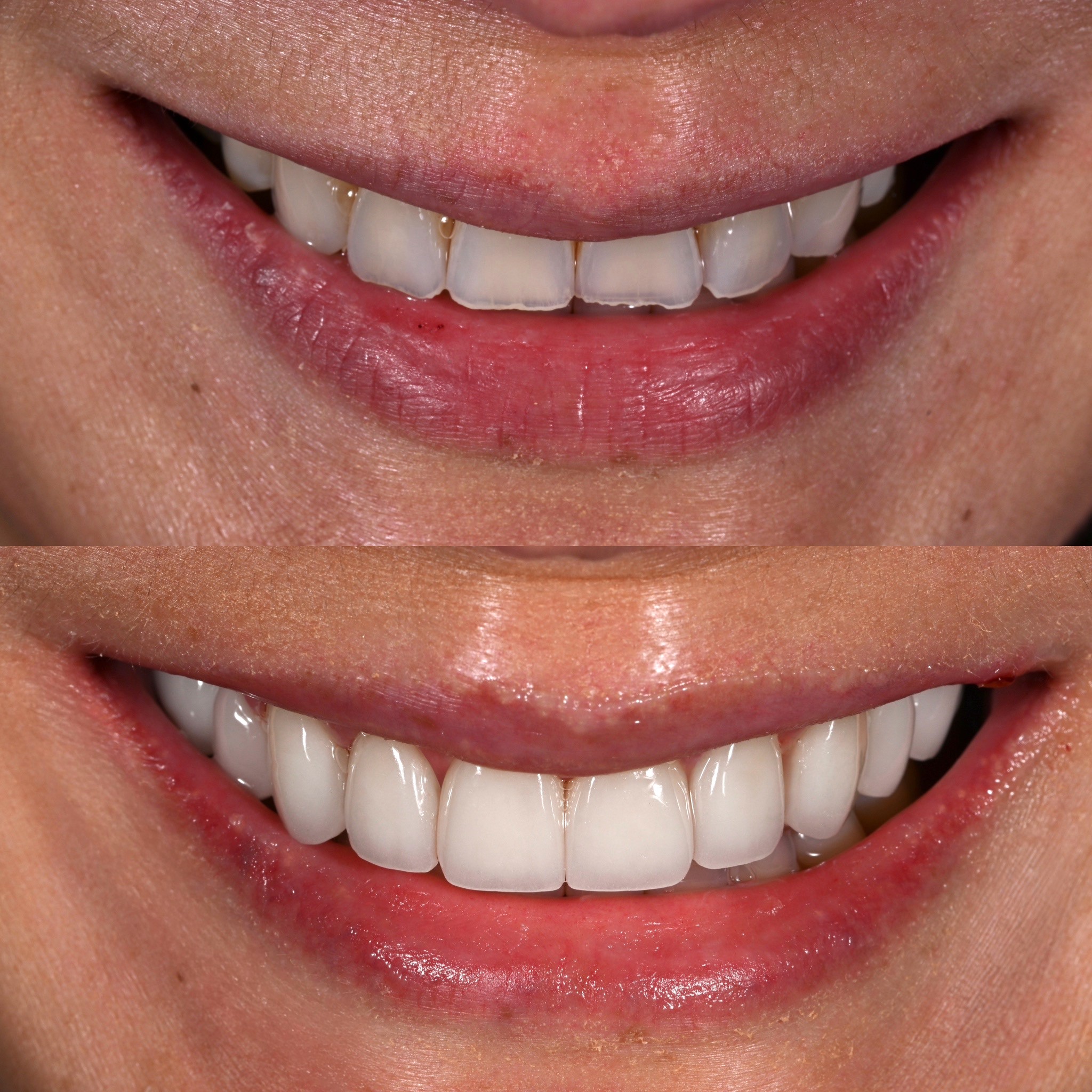 Veneer Case 12