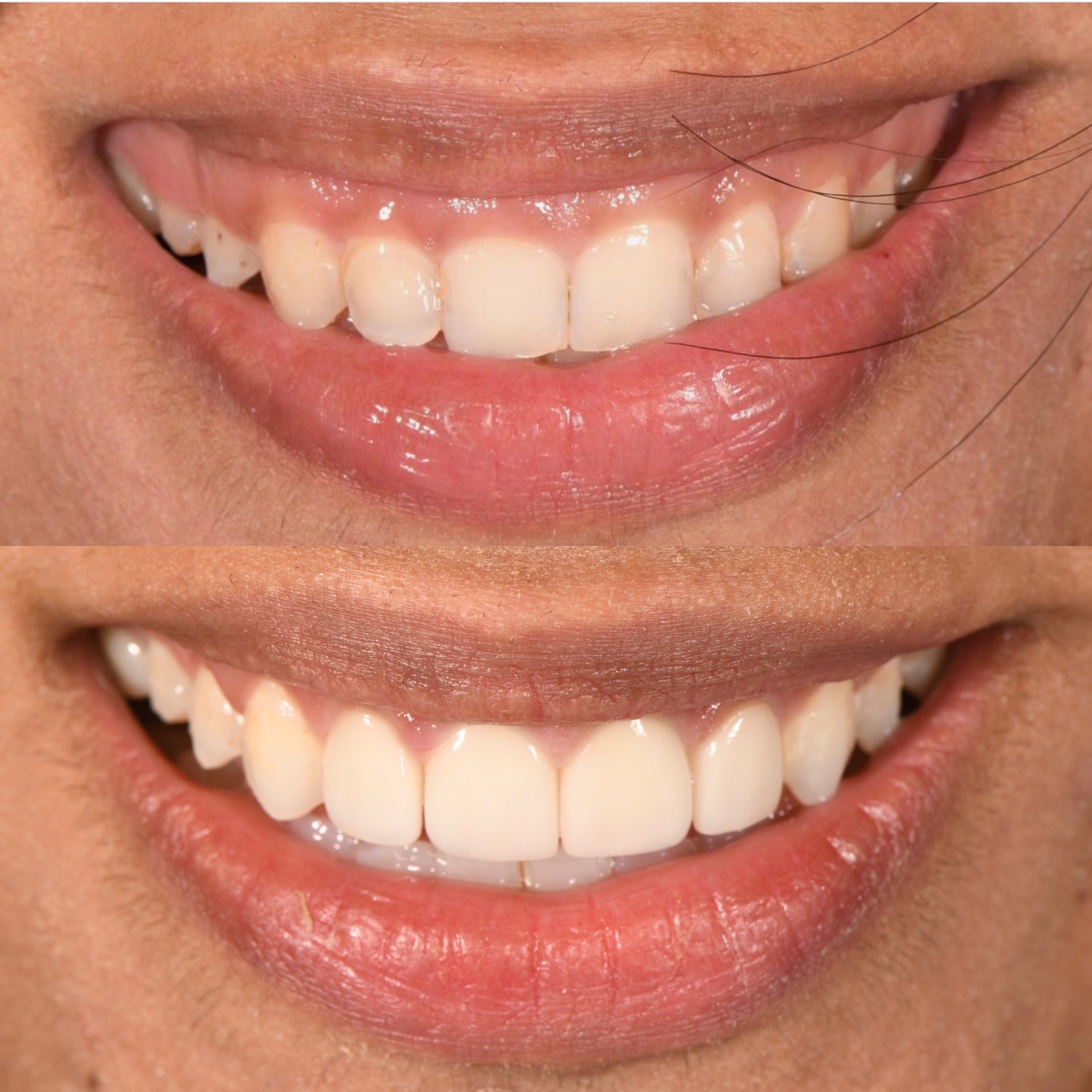 Veneer Case 10