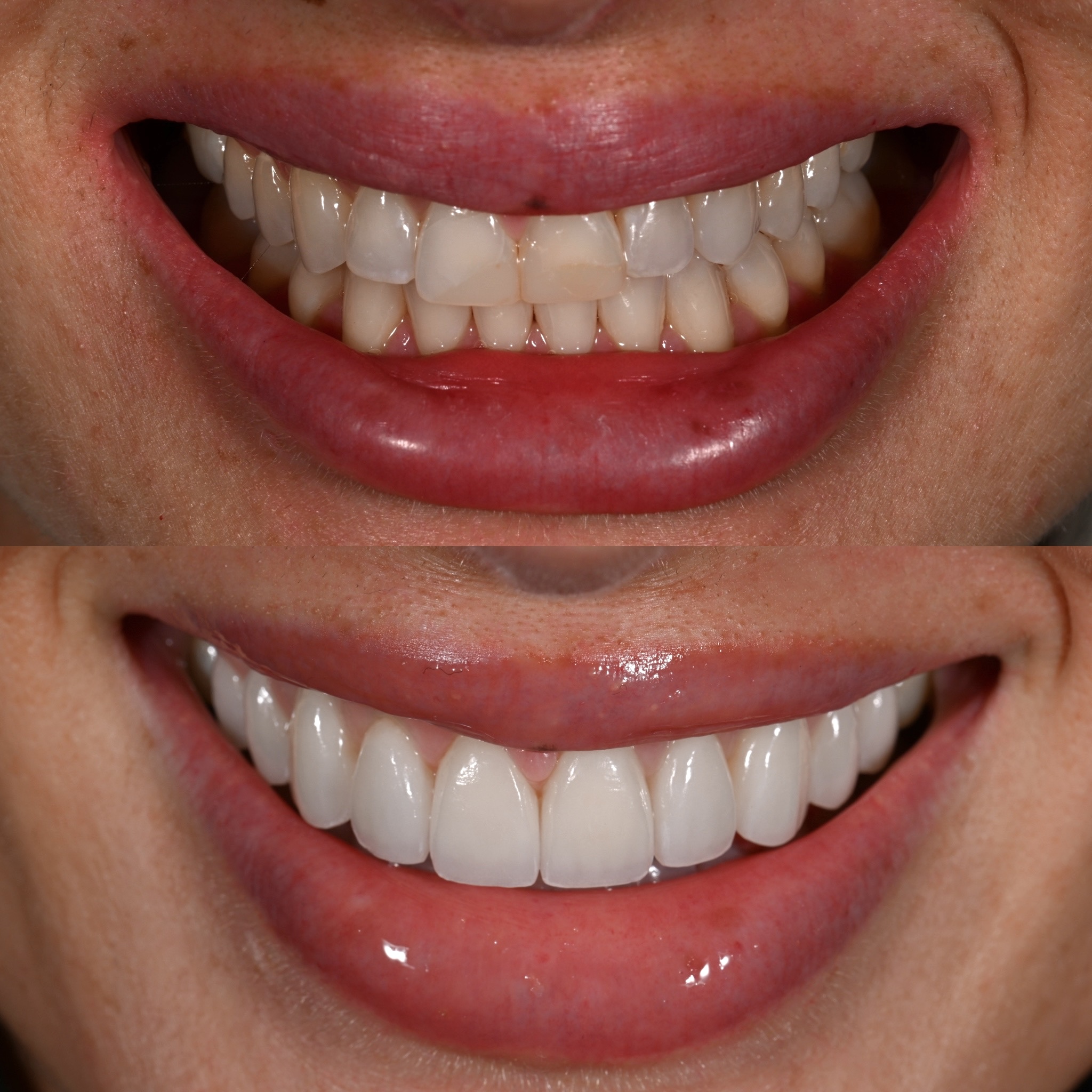 Veneer Case 3