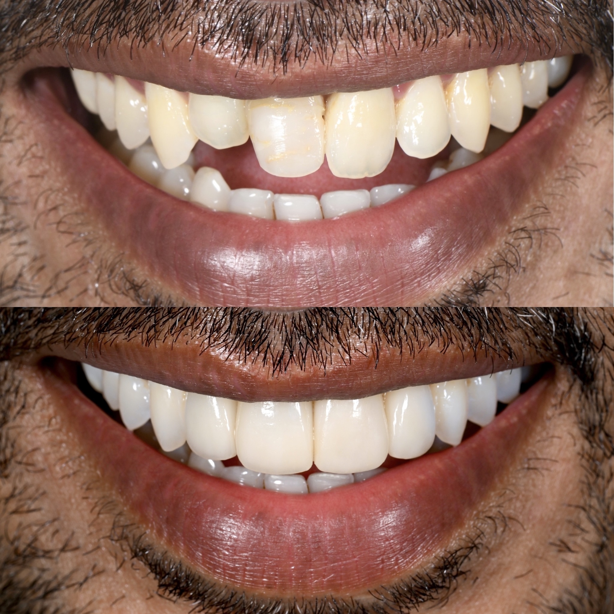 Veneer Case 25