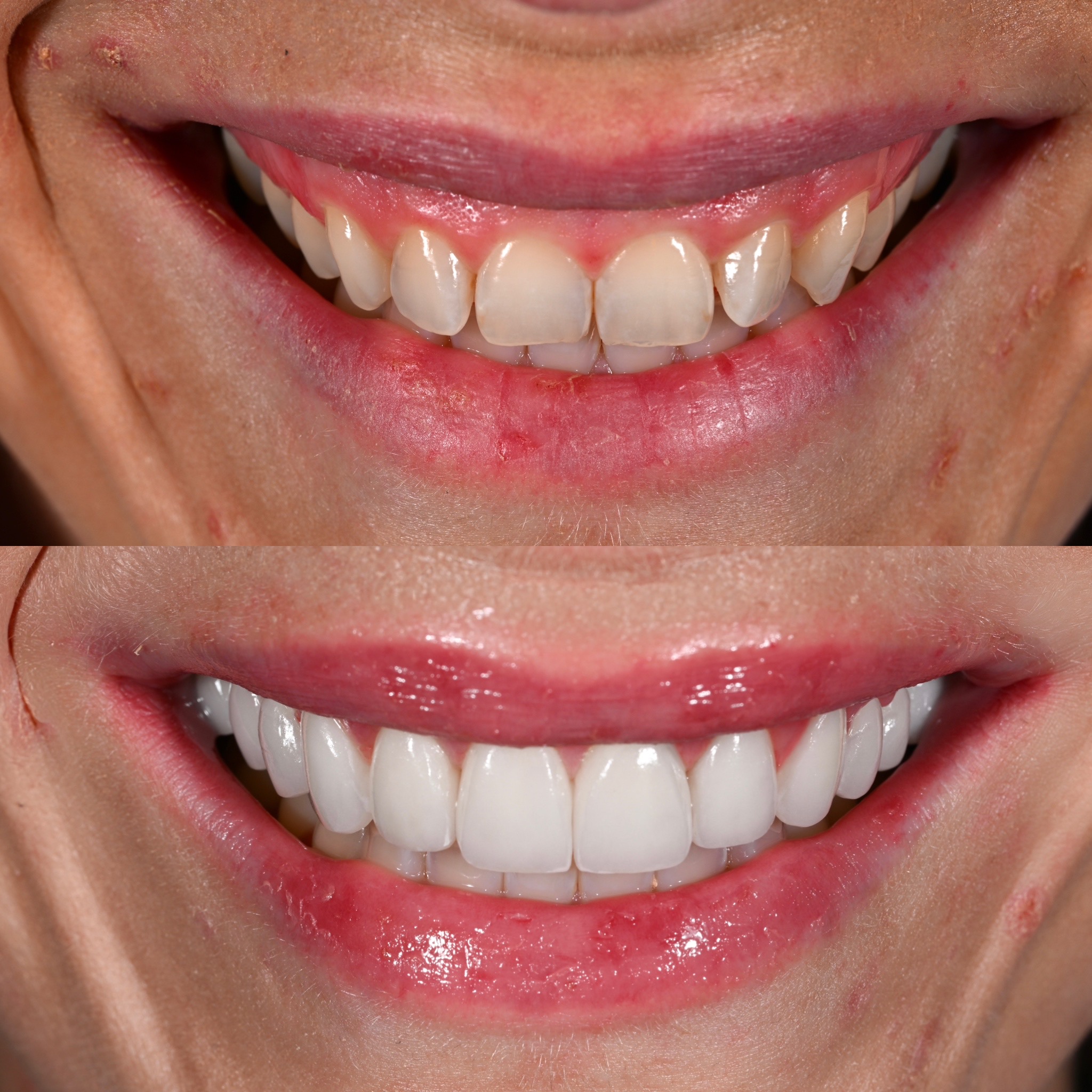 Veneer Case 2