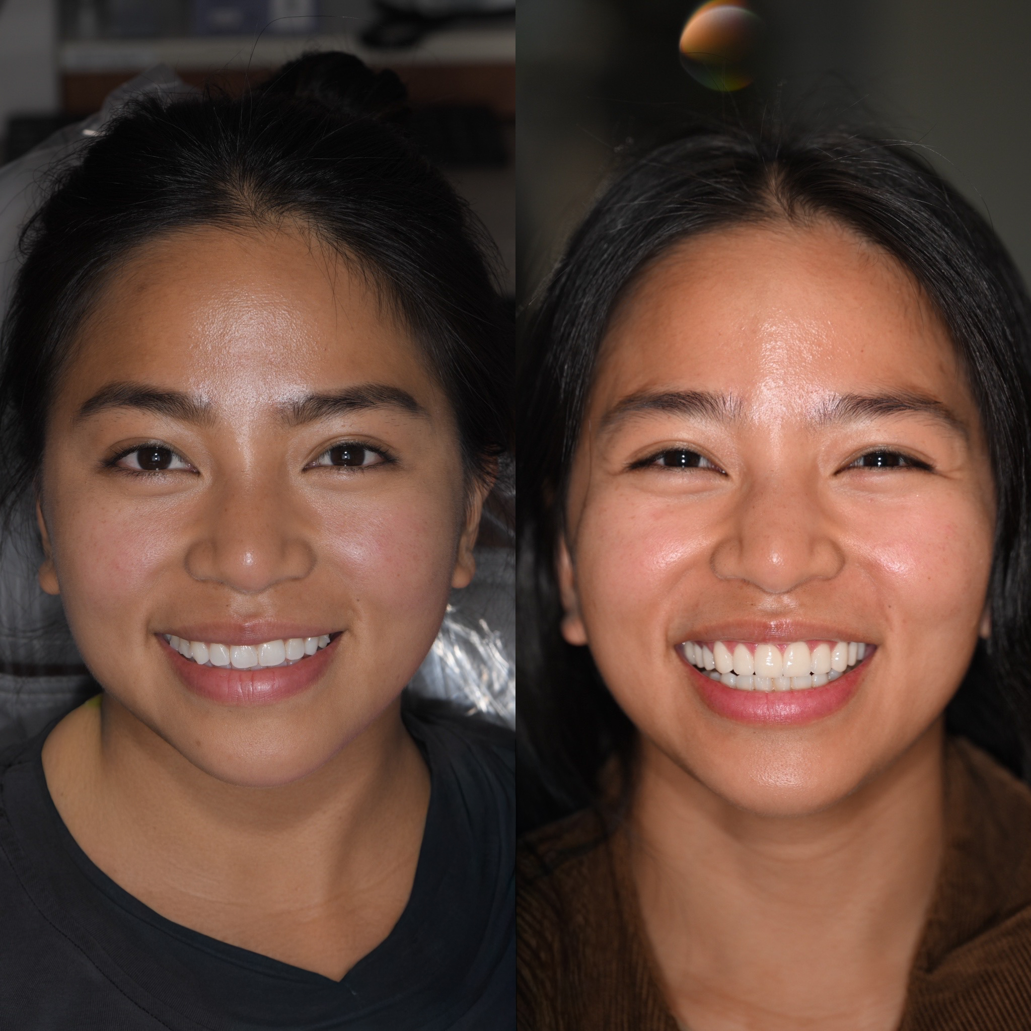 Janica's Veneers Smile Transformation