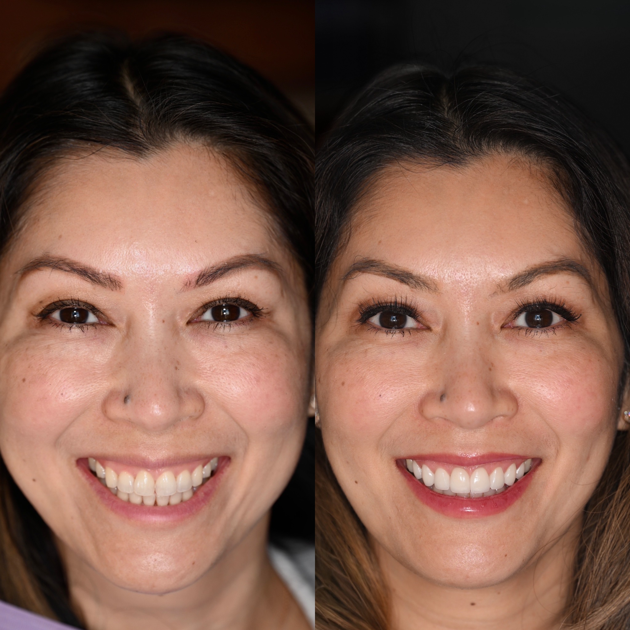 Aqua's Veneers Smile Transformation