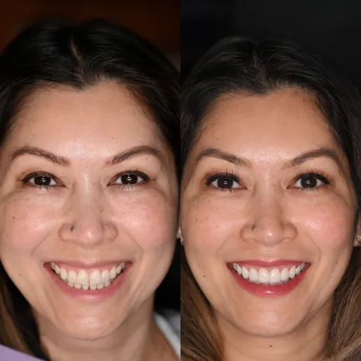 Smile Transformation Veneers
