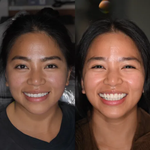 Veneers Closing Gaps