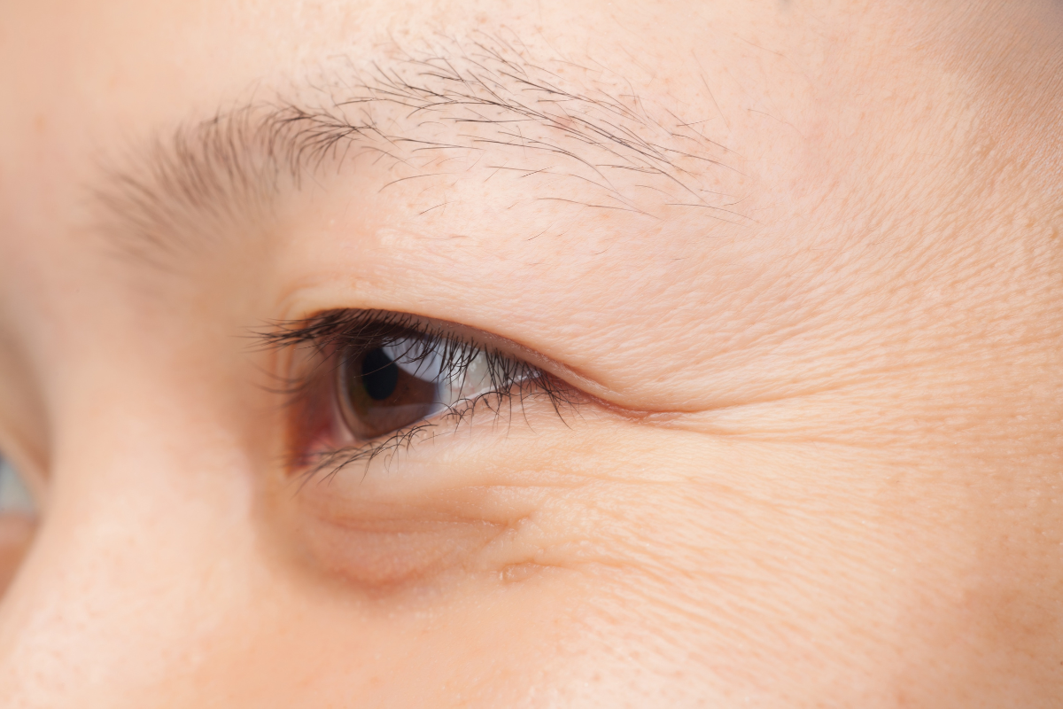 Fine lines & wrinkles