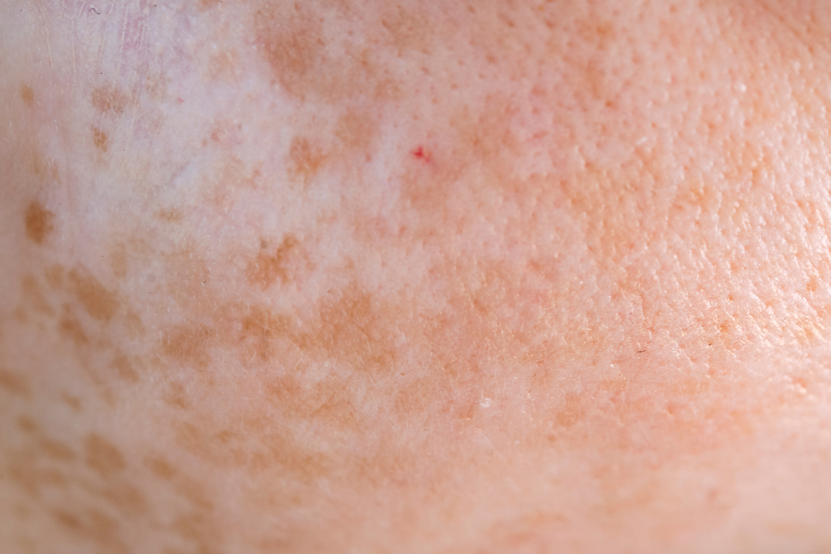 Pigmentation & sunspots