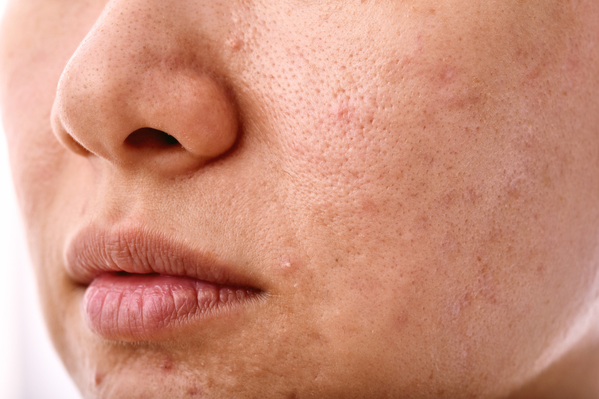 Dull uneven skin tone