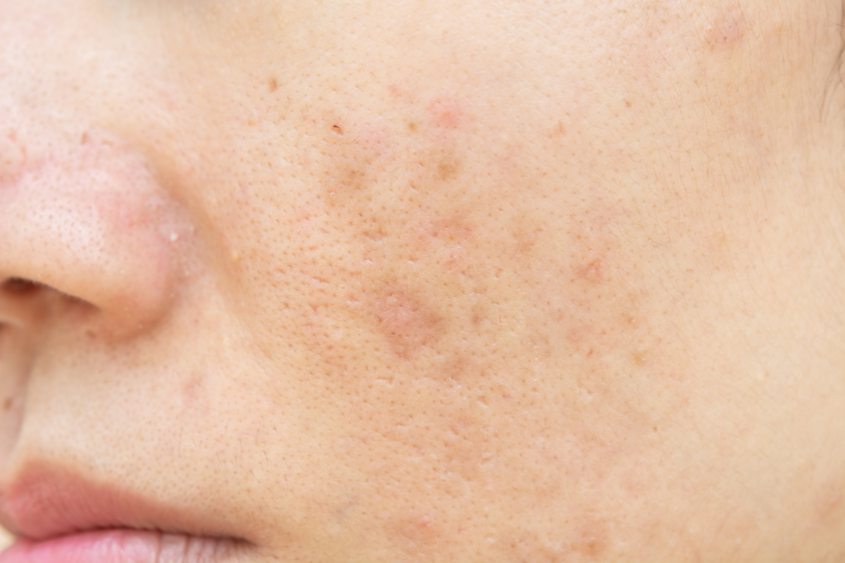 4 Acne scars & texture issues