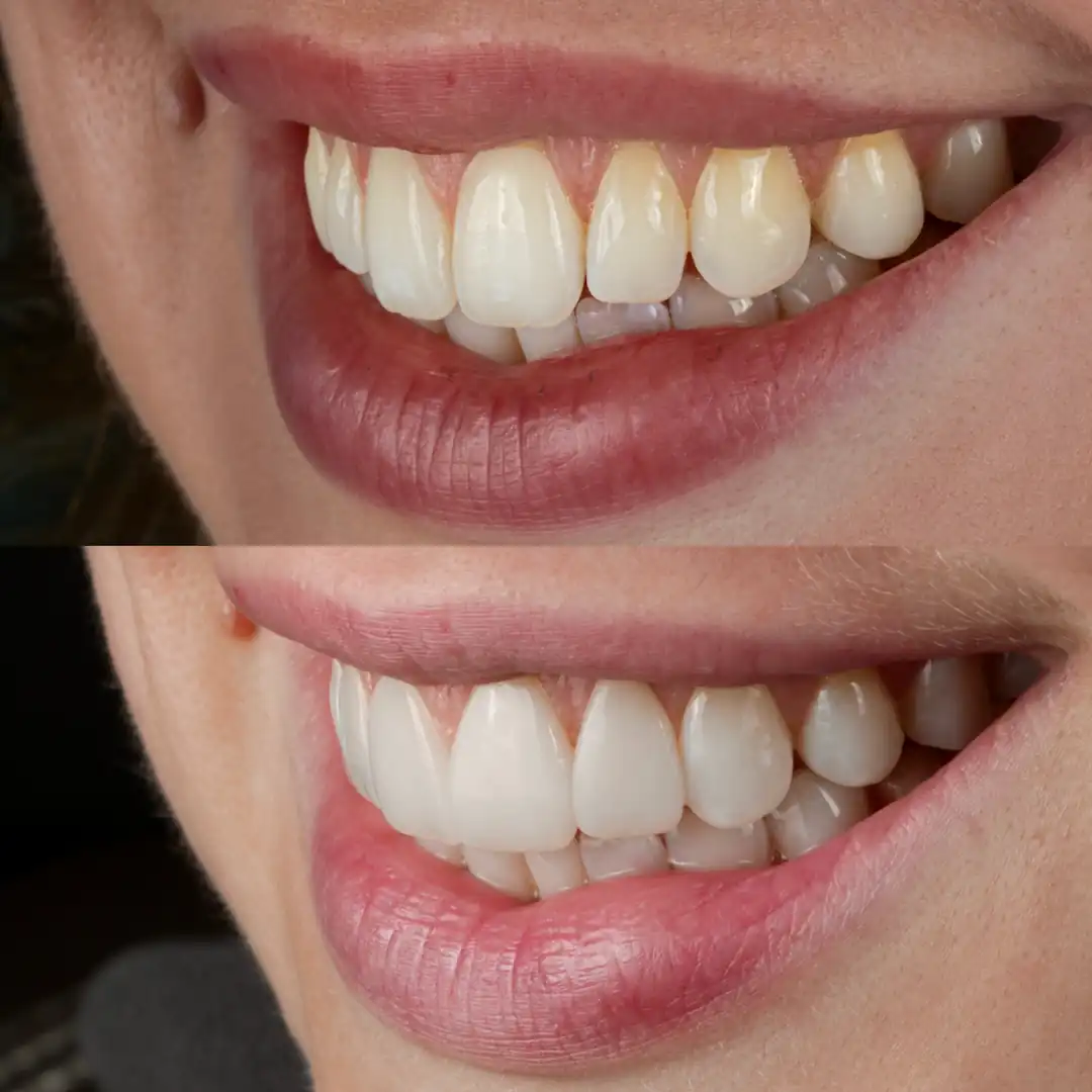 Before-and-after composite bonding creating improved symmetry and a softer smile at The Dental Barns near Lichfield and Sutton Coldfield.
